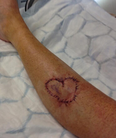 After surgery