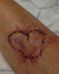 After surgery 2
